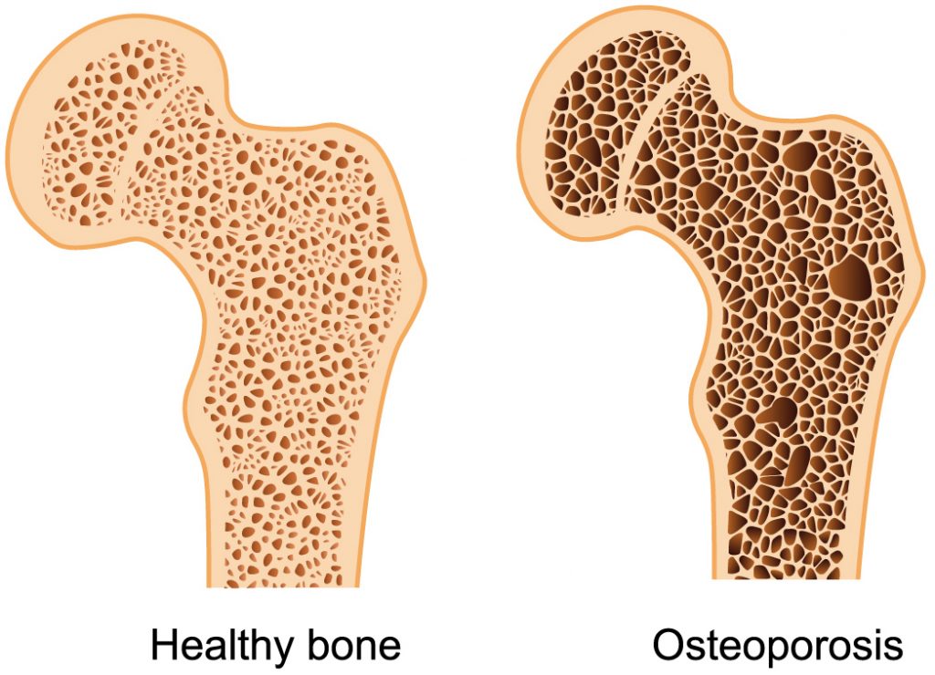 OSTEOPOROSIS ENTRENASALUD